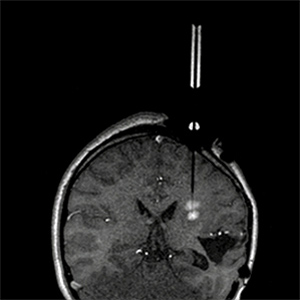 Un sistema que permite a los cirujanos obtener imágenes del cerebro mientras operan