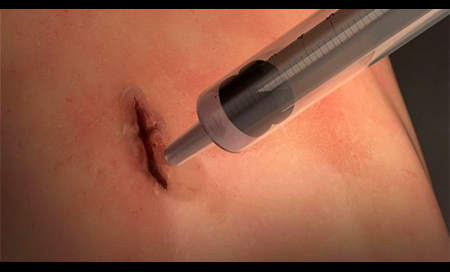 Un pegamento quirúrgico que sella heridas en segundos