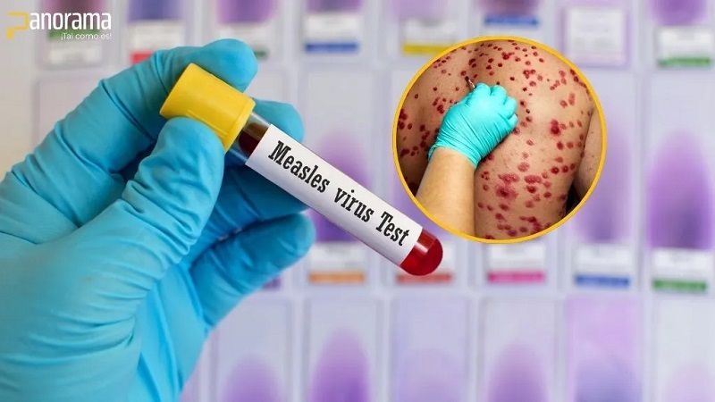 Muere un ni&ntilde;o y 146 casos identificados por el brote de sarampi&oacute;n en Texas